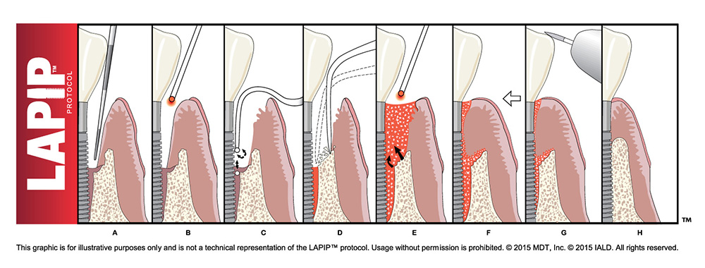 LAPIP steps diagram