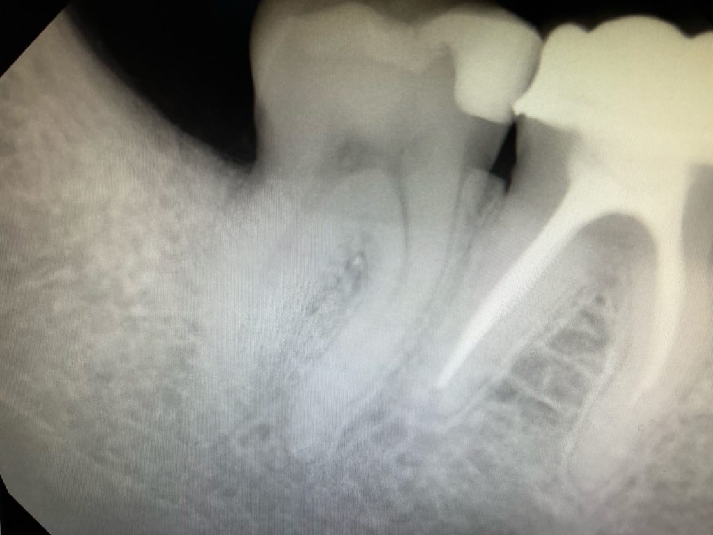 Guided Tissue Regeneration: Before